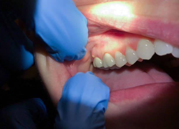 Best Emergency Wisdom Tooth Extraction in Magnet Cove, AR